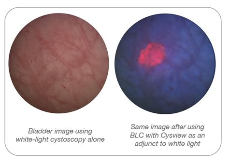 Enhanced Cystoscopy Including Blue Light Cystoscopy With Cysview® Hexvix® Is Recommended In The