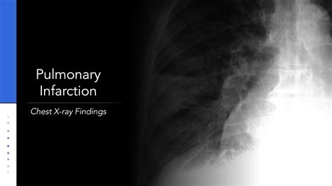 Pulmonary Infarction Chest X Ray Hamptons Hump Youtube