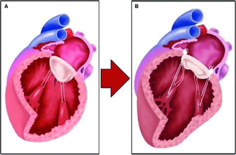 A Functional Impact Of Left Ventricular Remodelling On Mitral Valve