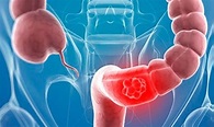Cáncer de colon: causas y tratamiento