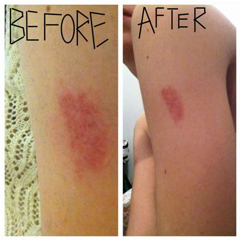 How To Get Rid Of Hickeys Secret Methods Holistic Meaning