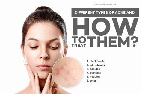 Different Types Of Acne And How To Treat Them Wonderlab