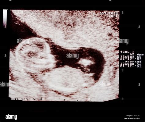 First Trimester Antenatal Ultrasound Scan At 3 Month Pregnancy Health