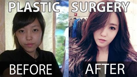 Kpop Artist Before And After Plastic Surgery