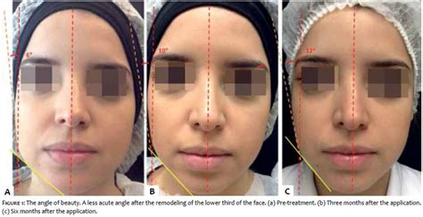 Surgical And Cosmetic Dermatology Thinning Of The Lower Third Of The