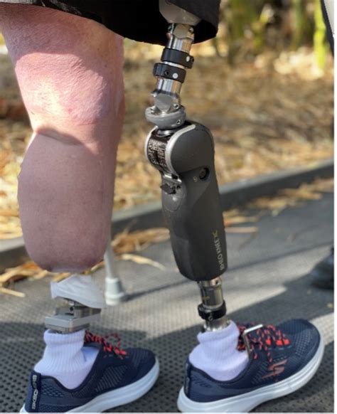 Neschopnost Postavení Nashromáždění Leg Prothesis Přízvuk Koňská Síla Tvar