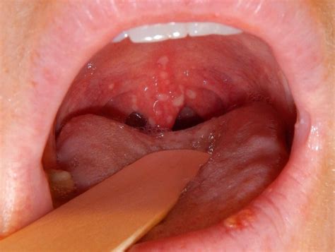 Can You Get Canker Sores In Your Throat