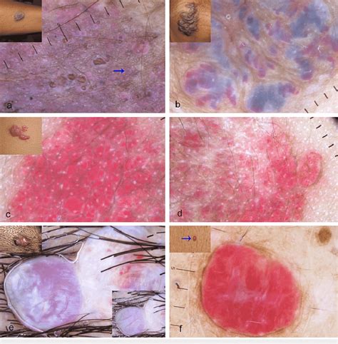 Dermoscopic Features Of Vascular Malformations And Tumors Polarized