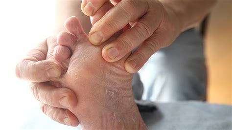 How To Treat Athletes Foot At Home