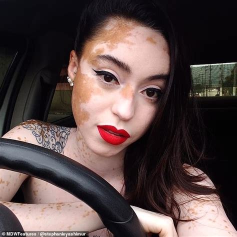 Brazilian Woman With Vitiligo Reveals It Has Turned Her Almost Completely White Daily Mail Online