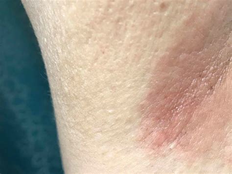 Arm Pit Redness Can Happen When You Break Out From Natural Deodorant
