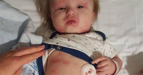Baby Struck Down By Meningitis For Second Time In Just Three Weeks As Horrifying Photos Show