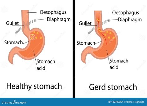 Gerd Stomach Acid Reflux Disease Infographic Medical Poster Vector Illustration Cartoondealer