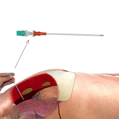 Decompression Needle Used To Treat A Tension Pneumothorax