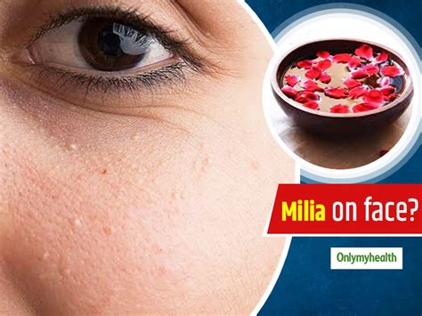Milia Removal At Home