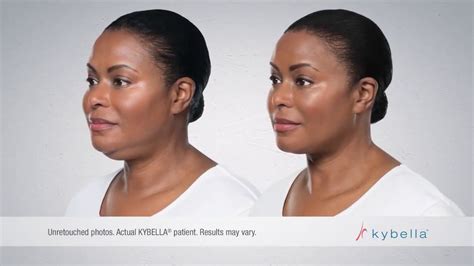 Kybella For Submental Fat Youtube