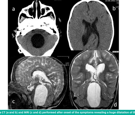 Figure 2 From Isolated Fourth Ventricle Associated With Treated