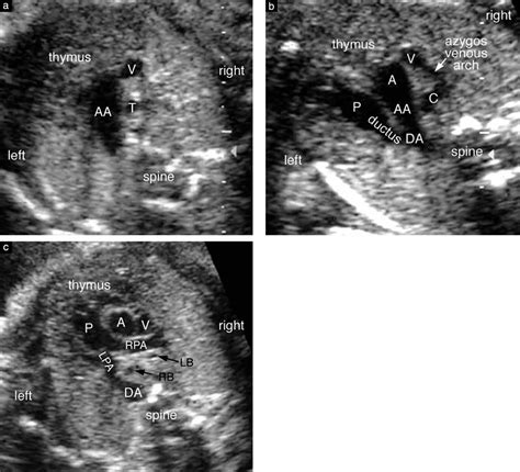 Fetal Sonographic Diagnosis Of Aortic Arch Anomalies Yoo 2003