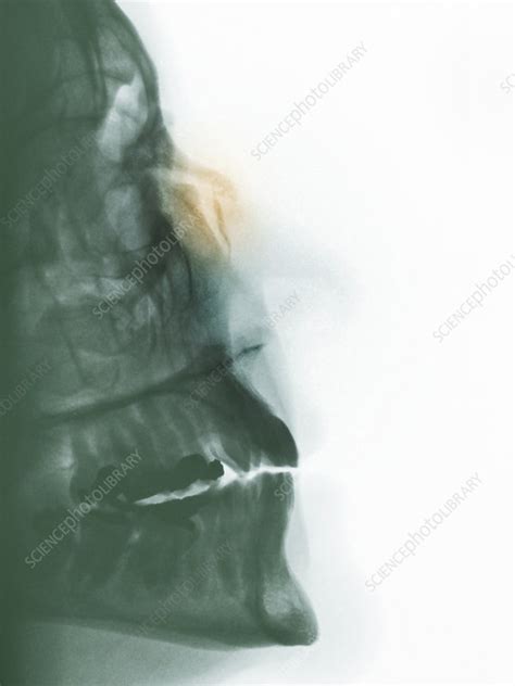 Nose Fracture Stock Image C0094800 Science Photo Library