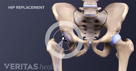 All About Anterior Hip Replacement