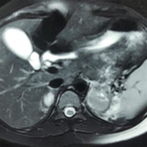 Axial T2 Image Of Mri Abdomen Showing Acute Hemorrhage On Left Side And