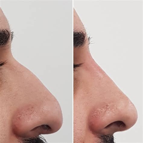 Bump On Nose Treatment Without Surgery Dr Aesthetica
