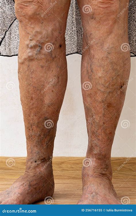 Senior Woman Bare Legs With Protruding Varix Spider Varicose Veins