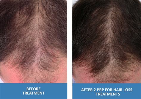 Prp For Hair Loss Platelet Rich Plasma In Springfield Missouri