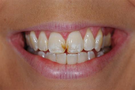 Stains Between Teeth How To Get Rid Of Black Spots Between Teeth