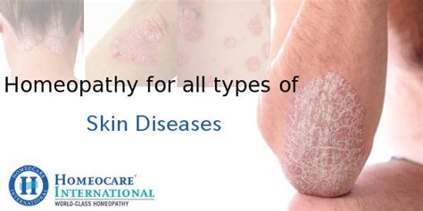 Skin Diseases Archives Homeocare International