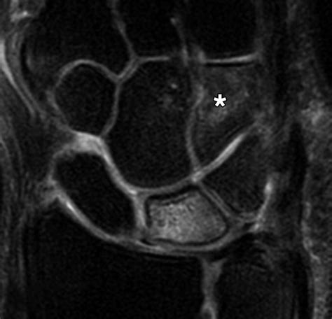 Imaging Of Kienb Ck Disease Ajr