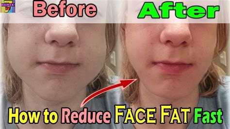 How To Get Fat Cheeks Naturally Youtube