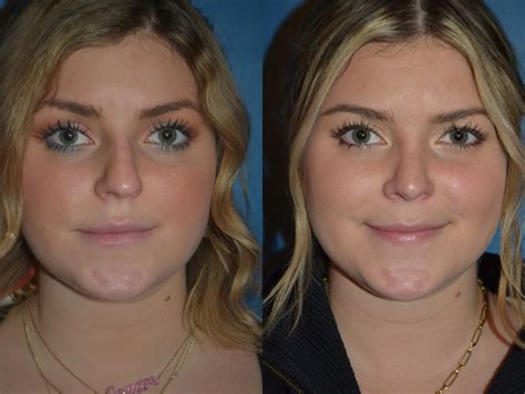 Before And After Rhinoplasty Photos Dr Miguel