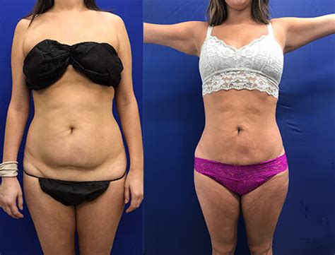 Abs And Waist Liposuction Before And After Neinstein Plastic Surgery