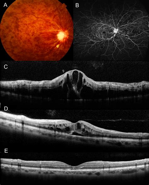 Persistent Metamorphopsia After Resolution Of Macular Edema Associated