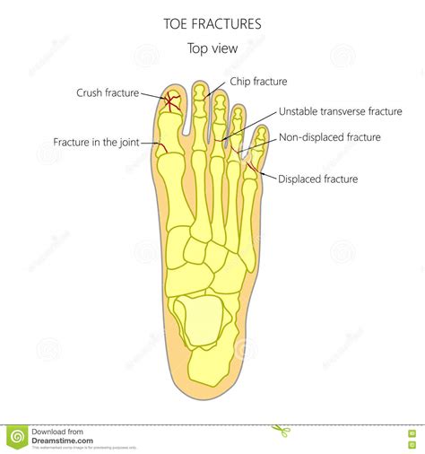 Toe Fractures Stock Vector Illustration Of Foot Apophyseal 77253823