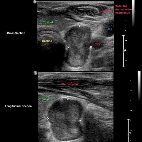 Parathyroid Ultrasound
