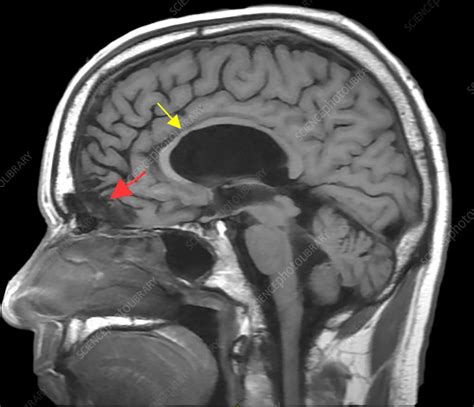 Chronic Post Traumatic Brain Injury Mri Stock Image C0306062