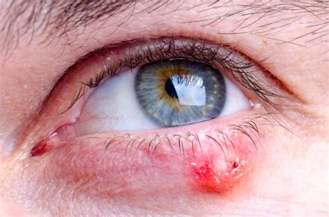 Stye Infection Stock Photos Pictures And Royalty Free Images Istock