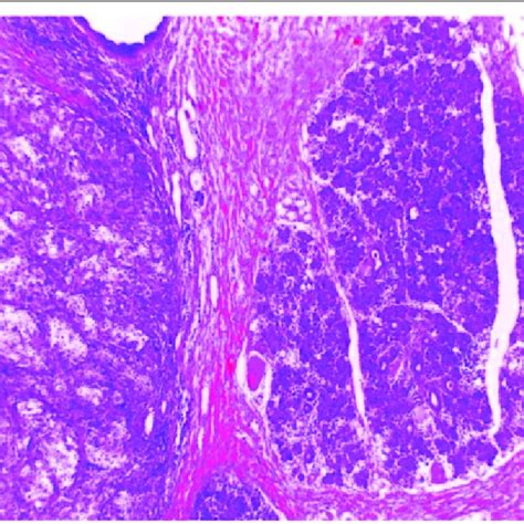 Pdf Parotid Gland An Exceptional Localization Of Sebaceous Carcinoma