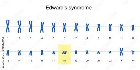 Edward S Syndrome Karyotype Vector Esp Stock Vector Adobe Stock