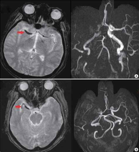 Figure 6 From Magnetic Resonance Imaging In Acute Ischemic Stroke