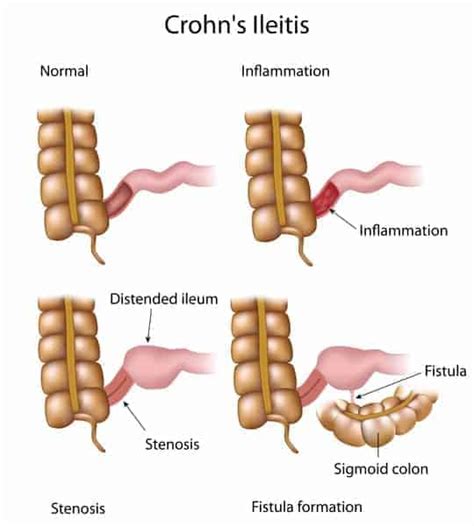 Crohns Disease New