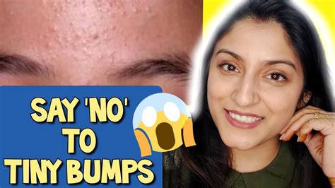 7 Days Challenge 😲 Treat Tiny Bumps On Foreheadsface Naturally 100