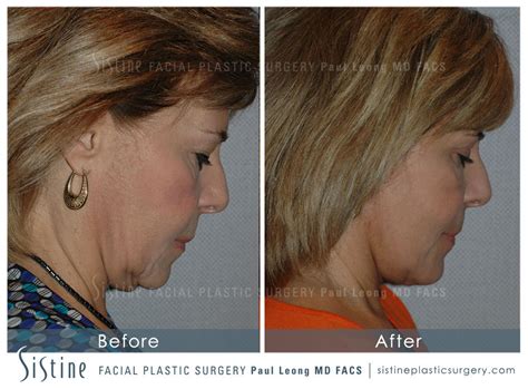 New york city man dennis c. Blepharoplasty Before and After 09 | Sistine Facial Plastic Surgery
