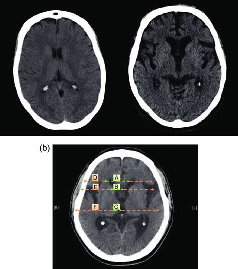 A A Brain Computerized Tomography Ct Of A Normal Control Left