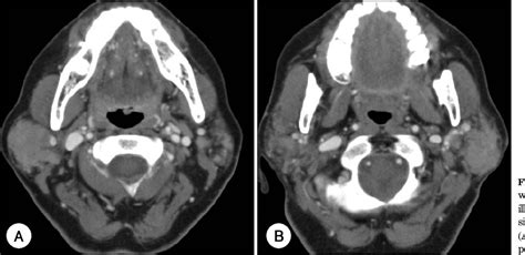 Figure 1 From A Case Of Multifocal Malt Lymphoma In Salivary Glands