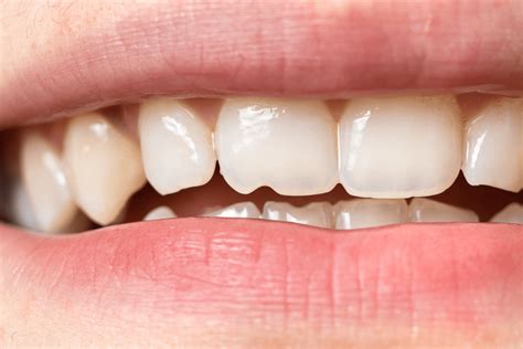 treating sensitive teeth what causes tooth sensitivity
