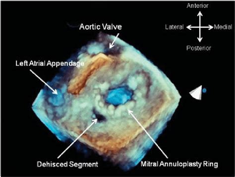 Surgical View Of The Mitral Valve A 3d Zoom Mode Acquisition Of A