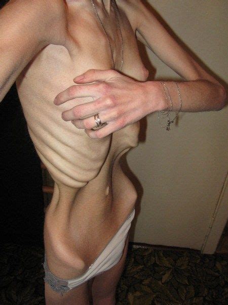 Extreme Anorexic Nude